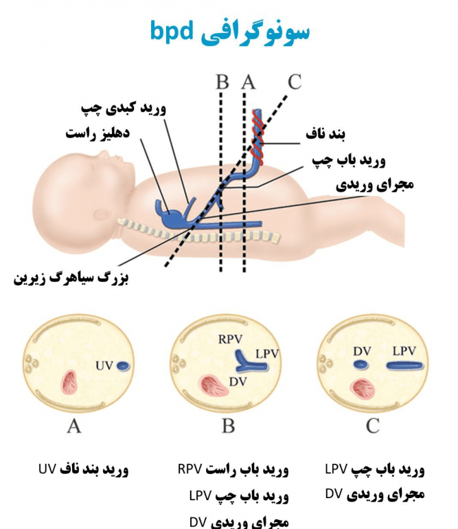 BPD در سونوگرافی چیست و اندازه گیری BPD چه معنایی دارد؟