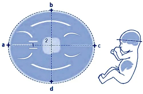 BPD در سونوگرافی چیست و اندازه گیری BPD چه معنایی دارد؟