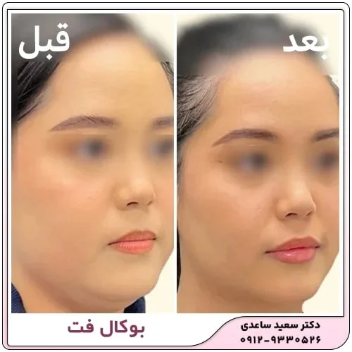آیا بوکال فت باعث پیری می شود؟