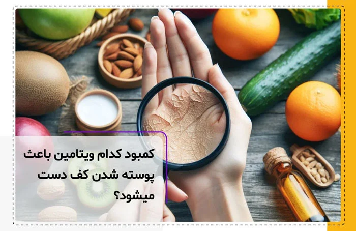 کمبود کدام ویتامین باعث پوسته شدن کف دست میشود؟